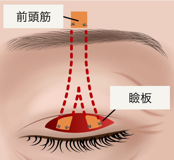 前頭筋吊り上げ術