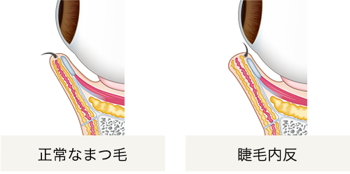 睫毛内反症
