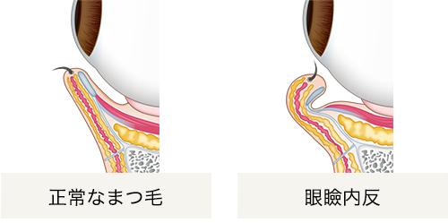 眼瞼内反症