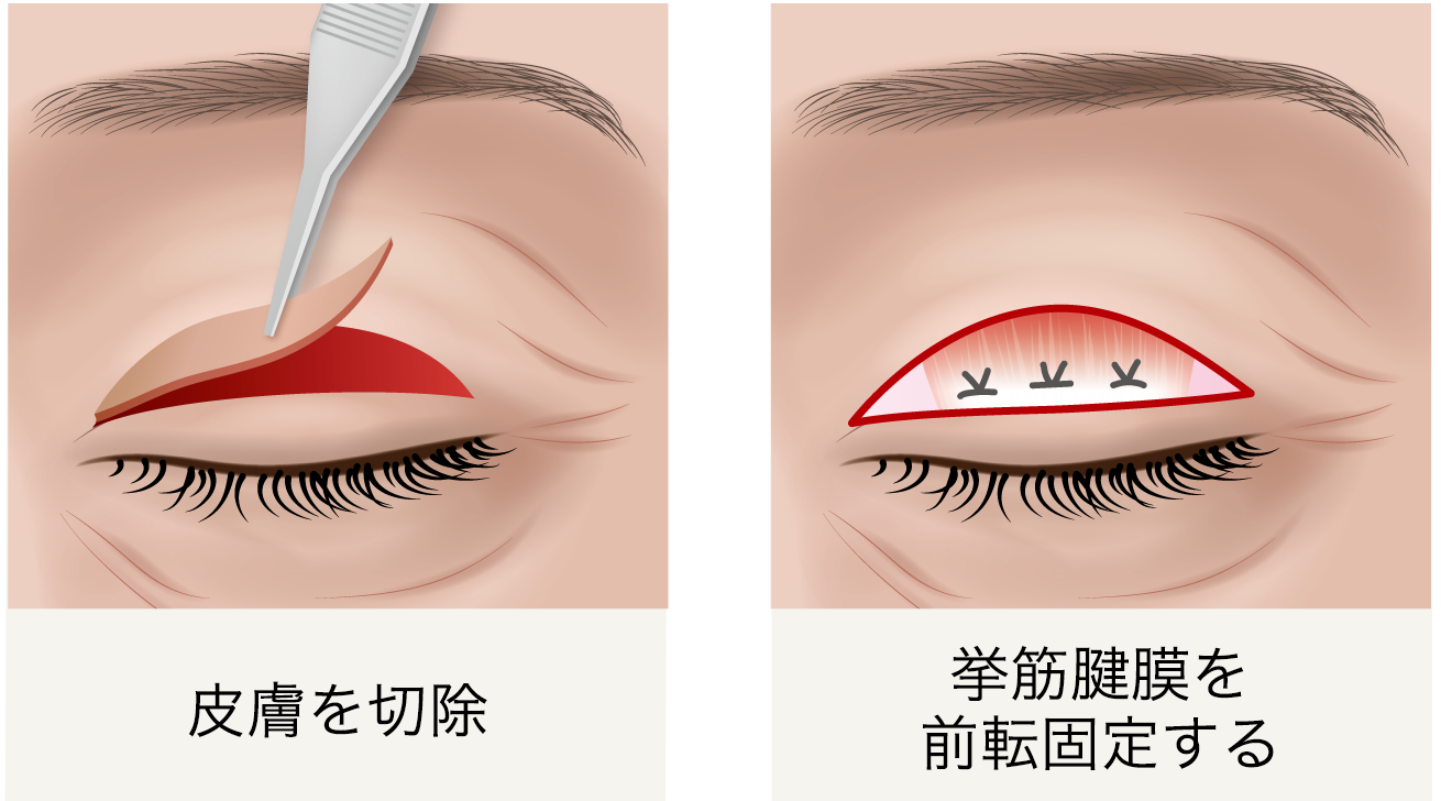 眼瞼下垂 挙筋前転法