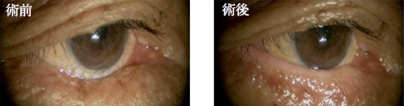 眼瞼内反症（縫合法）+外眥吊り上げ術